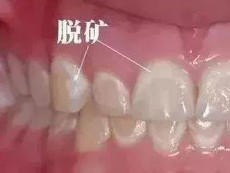 每天喝奶茶牙被腐蚀，警示与反思