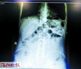 惊心动魄，揭秘女子灌肠肠道穿孔背后的真相与警示