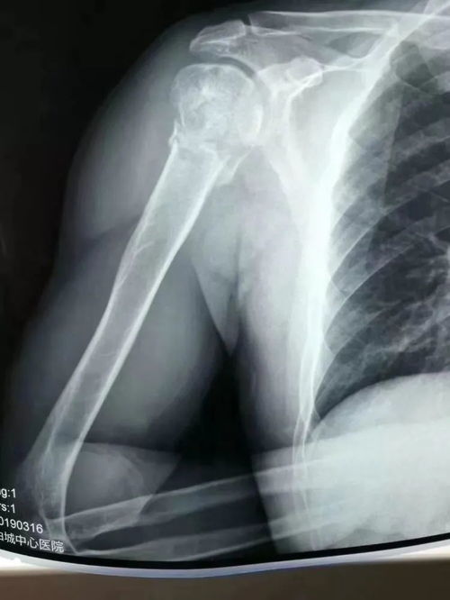 粉碎性骨折，当骨头碎成渣时，我们如何应对？